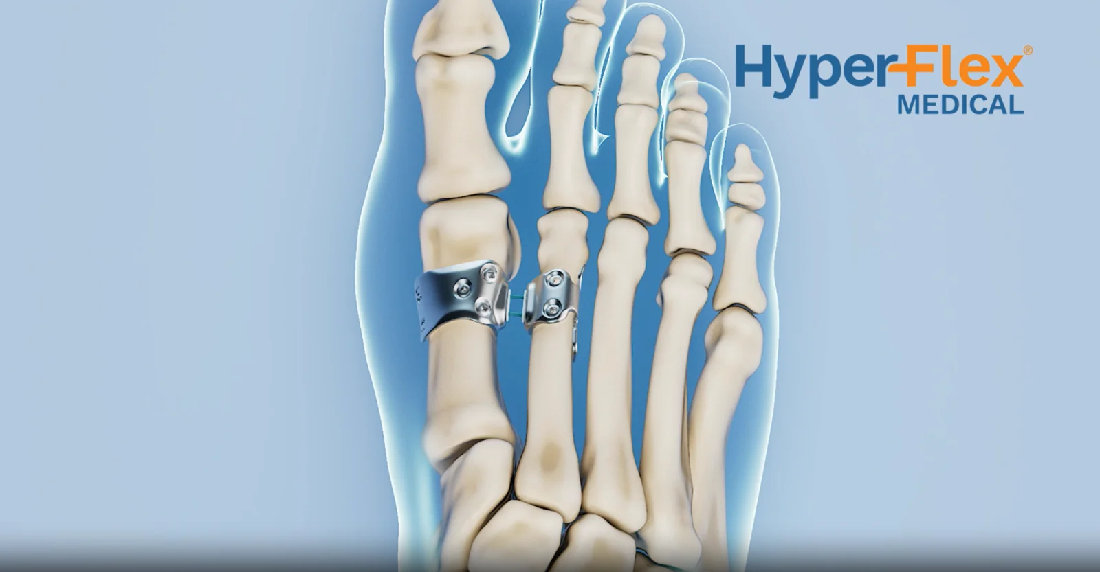 HyperFlex Medical – No bone cuts. No fusion. Just correction.